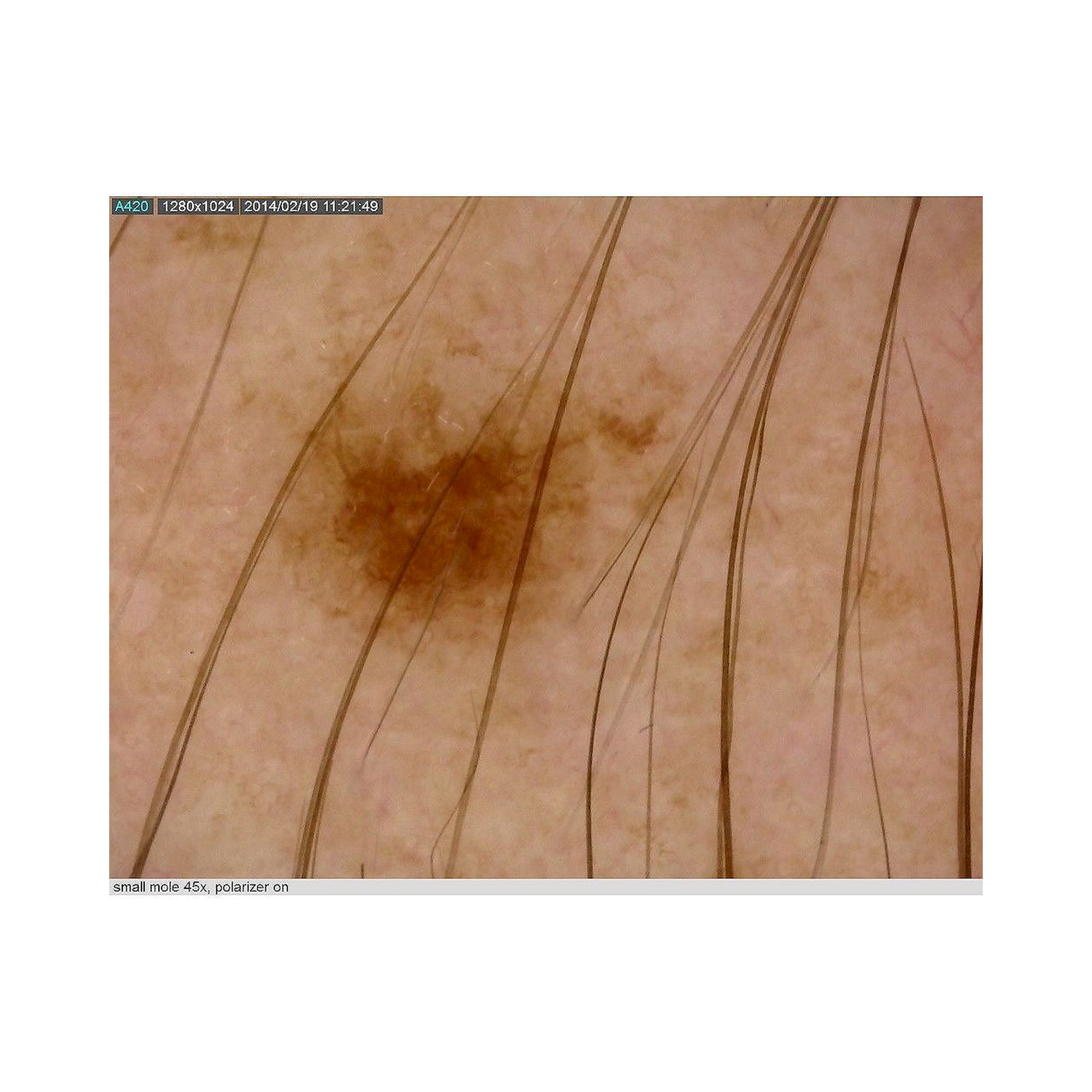 Capillaroscope 1.3 MP 500x with Polarizer Nailfold Capillaroscopy - Dino-Lite MEDL4N5