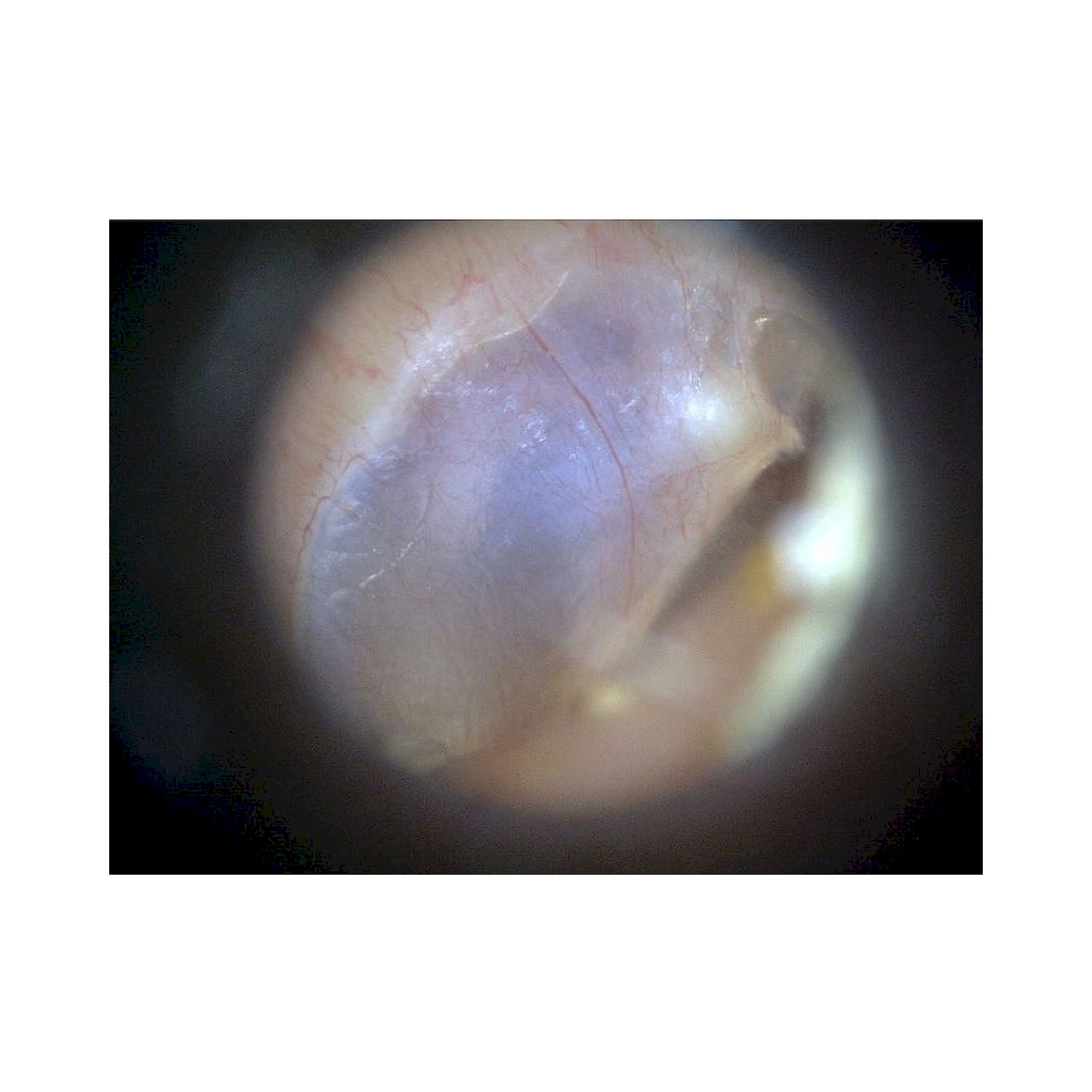 Otoskop-Kamera USB 1,3 MP 55-90x für die Otoskopie - Dino-Lite EarScope Pro